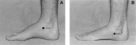 navicular drop test|navicular drop test normal.